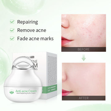 Anti Acne Cream
